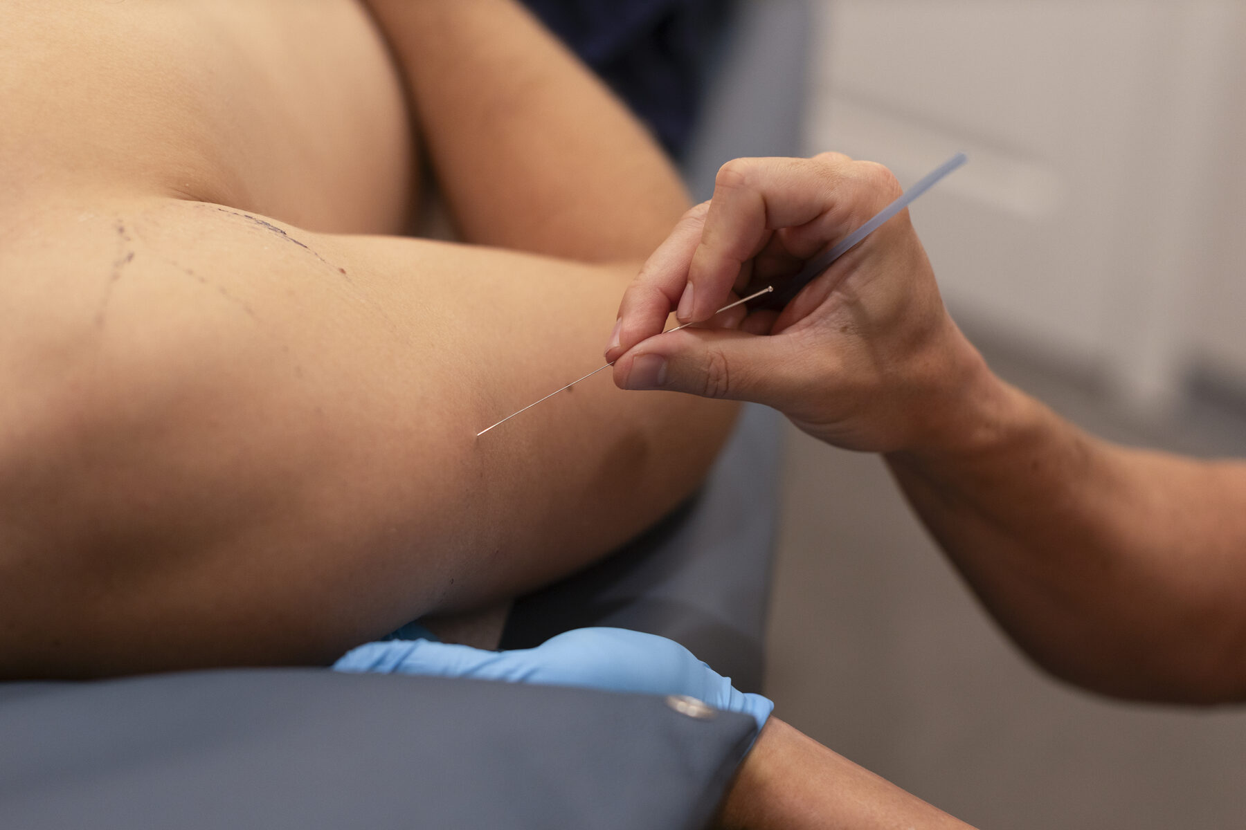 Dry needling treatment applied to a patient's arm