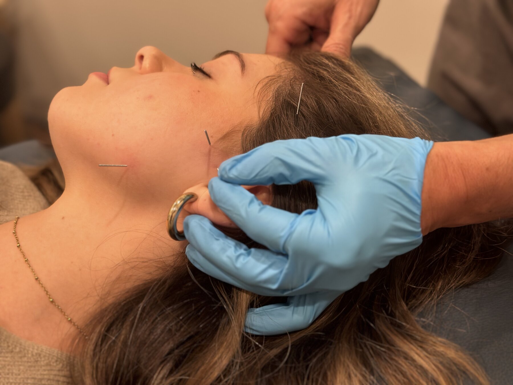 A patient receiving acupuncture near the temple and ear during headache treatment